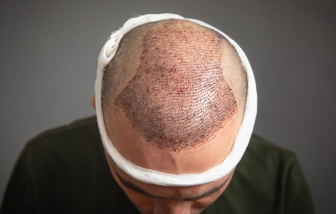 Saç ekimi sonrası saç derisindeki kabuklanma ve iyileşme süreci.